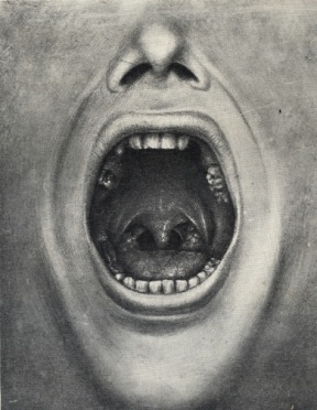 Illustration of a mouth with teeth removed from Cotton's book The defective delinquent and insane: the relation of focal infections to their causation, treatment and prevention.